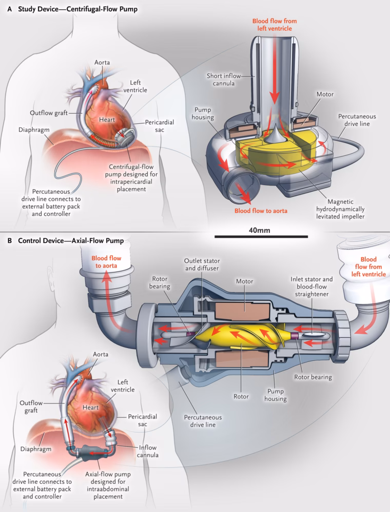 LVAD_CFD_Analysis_and_Optimization_of_a_Left_Ventricular_Assist_Device_nejmoa1602954_f1